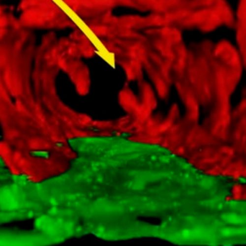 3D image shows how the more aggressive tumors feed on