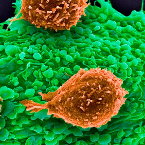 La técnica más avanzada de edición genética CRISPR pasa el ensayo clínico en tres pacientes de cáncer